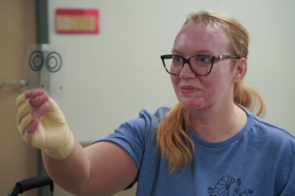 Determined Nebraska Mom Overcomes Burn and Brain Injuries