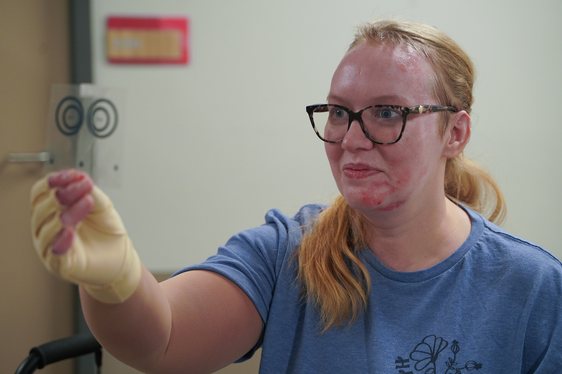 Patient Alyssa Kahle engages in hand exercises as part of burn and brain injury rehabilitation at Madonna
